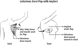 Diagram of Dorsi Flap with Implant